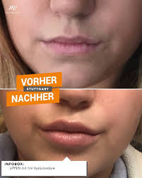 Aber wie weh tut es, die lippen aufspritzen zu lassen? Facebook