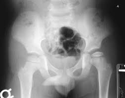 Perthes' disease is a condition where the top of the thigh bone in the hip joint (the femoral head) softens and breaks down. 26 Legg Calve Perthes Disease Radiology Key