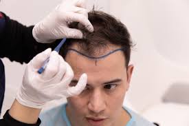 Hair Transplantation: The Permanent Solution for Hair Loss – RHC Clinic