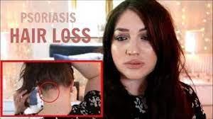 With an oil or lotion, part your hair and drip the medication onto your scalp. My Hair Loss And Psoriasis Story Youtube