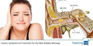 Learn Everything About Ear Wax Removal Buildup Blockage Removal Kit Diagnosis Treatments Best Ear Wax Removal Ear Cleaning Wax Natural Ear Wax Removal