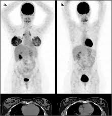 A pet scan will help detect cancer and show how far it has spread. Physiologic And Hypermetabolic Breast 18 F Fdg Uptake On Pet Ct During Lactation Springerlink