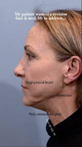 Revision deep plane face and neck lift was performed along with the lower  blepharoplasty and the fractionated CO2 laser resurfacing to address my  patient's goals. Dynamic wrinkles were softened with ...