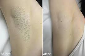 Before & after photos from armpits to bikinis and legs to lips, the effectiveness of laser hair removal at milan is unparalleled. Facebook