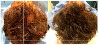 What is the best hair gel for men? Biomedicines Free Full Text Platelet Rich Plasma And Micrografts Enriched With Autologous Human Follicle Mesenchymal Stem Cells Improve Hair Re Growth In Androgenetic Alopecia Biomolecular Pathway Analysis And Clinical Evaluation Html