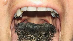 Image result for black hairy tongue symptoms