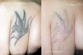 It can be easy to get caught up in the excitement of the moment, and although it seemed like a good idea at the time, you may find. Tattoo Removal Inkfree Md Laser Clinic Houston Tx