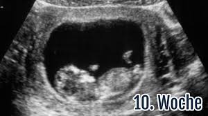 Einzelne regionen des gehirns bilden sich in der 9. 10 Ssw Die 10 Schwangerschaftswoche Ultraschall Bauch Tipps Netmoms De