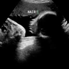 Or any one have comparisons from previous children, hair on ultrasound vs hair at. Baby Hair On Ultrasound July 2015 Babies Forums What To Expect Page 2