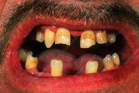 Image result for Dentition
