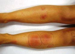 В основе механизма развития процесса лежит. Uzlovaya Eritema Nizhnih Konechnostej