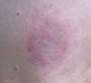 Il s'agit d'une maladie infectieuse non contagieuse. Erytheme Migrant Wikipedia