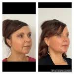 Facelift/Neck Lift Albuquerque NM, D. Eric Tuggle, D.D.S.