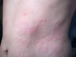 What To Know About Chronic Idiopathic Urticaria And Your Thyroid Urticaria Thyroid Thyroid Health