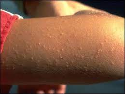 Get Rid Of Chicken Skin Keratosis Pilaris Beauty Care Beauty Hacks Keratosis Pilaris