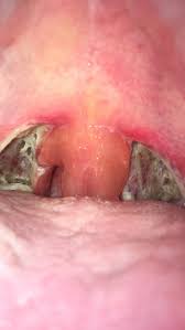 We did not find results for: 1st Day Tonsillectomy Uvula Is The Size Of A Golf Ball And It Looks Like I Ve Got Cheese Melted Into My Throat Popping
