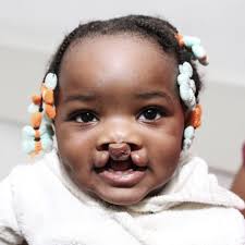 Meet Alegria from Angola! 🇦🇴 Alegria was born with a cleft lip and  palate. Concerned, her parents jumped into action to help their daughter.  Soon they found Smile Train's local partner, @belarisufoundation.