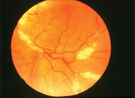Image result for HIV Retinitis