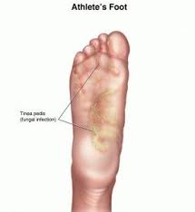 15 Home Remedies For Athlete S Foot Home Remedies Home Health Remedies Athletes Foot Remedies