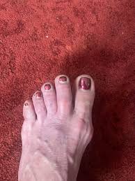 Image result for Pitting nails feet