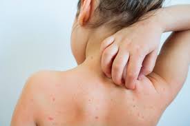 Image result for dermatitis contacta children