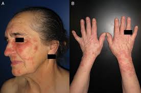 Image result for Erythema Multiforme