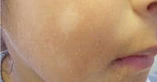 What Are Those White Spots On My Child S Face White Skin Spots White Skin Patches Brown Spots On Face