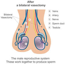 Image result for Vasectomy