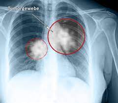 Rontgen Thorax Lunge Grunde Ablauf Bilder Praktischarzt