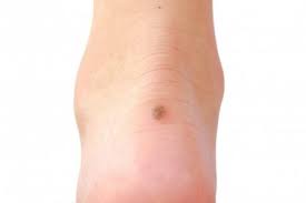 You can imagine it's like looking through a forest trying to find a single tree. Skins Cancer And Your Feet What You Should Know Foot Surgery In Minnetonka