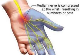 Barre syndrome as a cause of acute flaccid. Carpal Tunnel Syndrome Recharge Sports Injury Center Modern Chiropractic Care