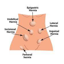What To Expect At The Doctor's During Hernia Test