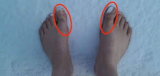 Best Hallux Rigidus Shoes For Turf Toe Turf Toe Nice Shoes Hallux
