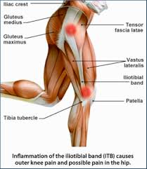 Diagram for injection area glutes injection photos (thanks to spot injections). Your It Band What Why How Acupuncture San Francisco Acupuncture For Fertility And Pain In Sf Area