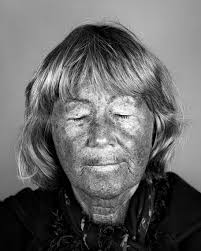 Cara Phillips Ultraviolet Photographs Show Sun Damage