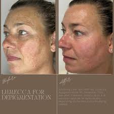 Leah Fraser: Advanced Skin and Laser (@proteaskinandbeauty) • Instagram  photos and videos