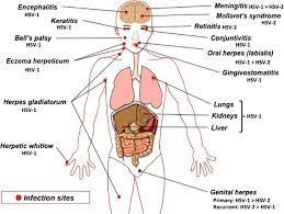 There are two types of hsv: Herpes Simplex Virus 1 Hsv 1 An Overview Virology Microbe Notes
