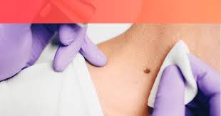 Como Quitar Las Verrugas Del Cuello