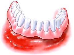 Ich habe gelesen, die cover denture sei parodontalhygienisch ungünstig, was ist damit genau gemeint? Deckprothese Behandlungsablauf Kosten