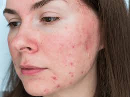 Image result for demodex rosacea