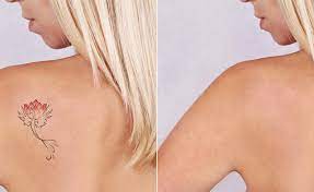 Laser is one of the most popular ways to rid yourself of an unwanted tattoo. 80 Off Painless Picoway Tattoo Removal From Dr Boulos Medical Spa Wagjag