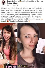 There is no complicated skin regimen that you have to follow, nor is there any pain or discomfort associated with the skin supplement. Crystal Tomato Plus Supplement Your De Botani Clinic Facebook