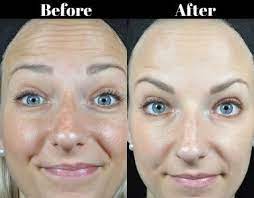 Botox antibodies for your research. The New Baby Botox This Is Exactly What Happens To Your Face Healthista