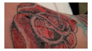 But in case if you. Tattoo Allergy Rash And Other Reactions To Ink Treatment More