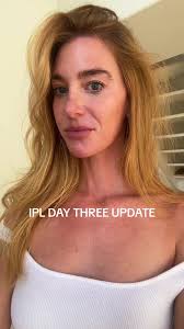 Ipl Freckles Arms