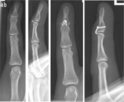 Hyperflexion of the dip joints may result in avulsion of the distal phalanx base on the dorsal side. Patient Satisfaction After Hook Plate Treatment Of Bony Avulsion Fracture Of The Distal Phalanges European Journal Of Medical Research Full Text