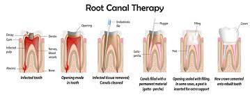 The Real Dangers Of Root Canals And Oral Health Tips