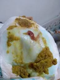 Cuando las cacas / heces de nuestro perro tienen un aspecto gelatinoso, como con moco por encima de color blanco o verde, que parece envolverlas, es porque 3 moco en las heces por la alimentación. Caca Con Moco Con Sangre Emergencias Pediatricas Babycenter