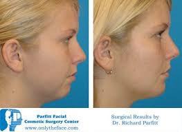 Parfitt Facial Cosmetic Surgery Center, 332 N Mall Dr, Appleton, WI 54913,  US