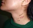 Brazilian Laser Hair Removal Results